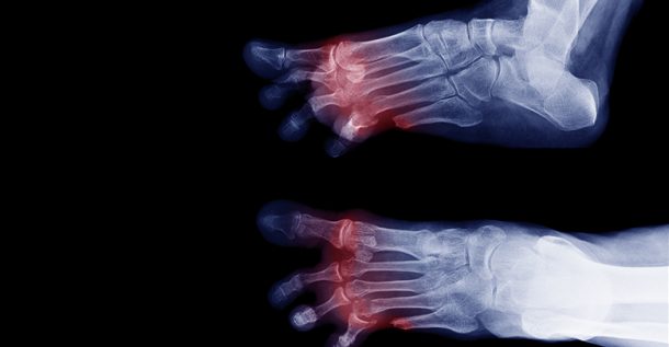 Lower Extremity Amputations Are Most Common in Type 1 Patients